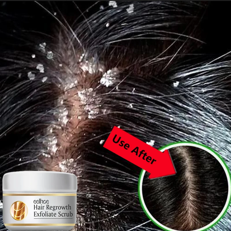Hair Care Dandruff - Tratamiento Capilar Anticaspa Rápido, Exfoliante, Repara