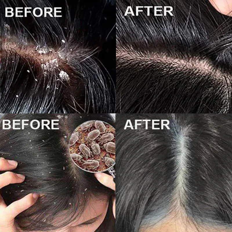 Tratamiento Capilar Anticaspa  - Hair Care Dandruff reseña y precio